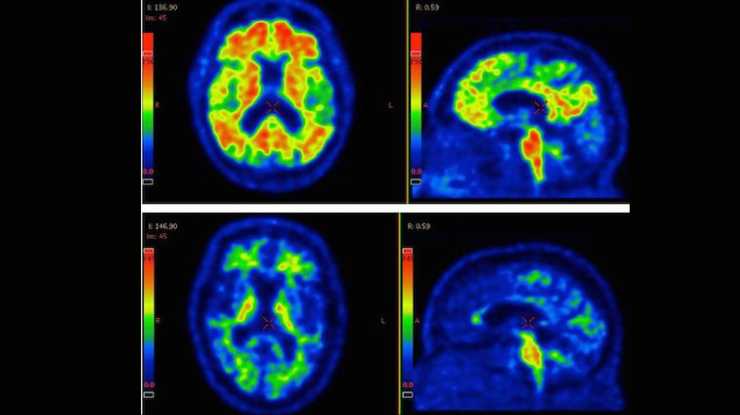 he illuminated spotes (red, yellow and green) indicate an accumulation of the protein beta-amyloid. The top row shows the brain of a patient diagnosed with Alzheimer's disease. Bottom row shows a brain from a healthy person. There are always some nonspecific binding of color markers, hence the bright spots in the healthy person.