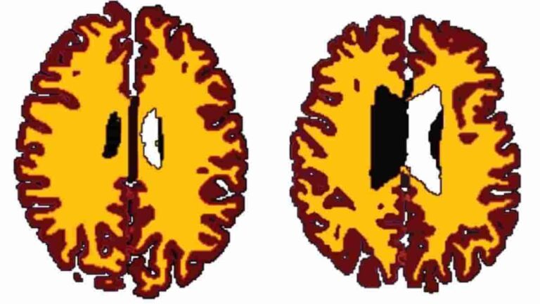 Middle Aged Obese People's Brains 10 Years Older Than Average