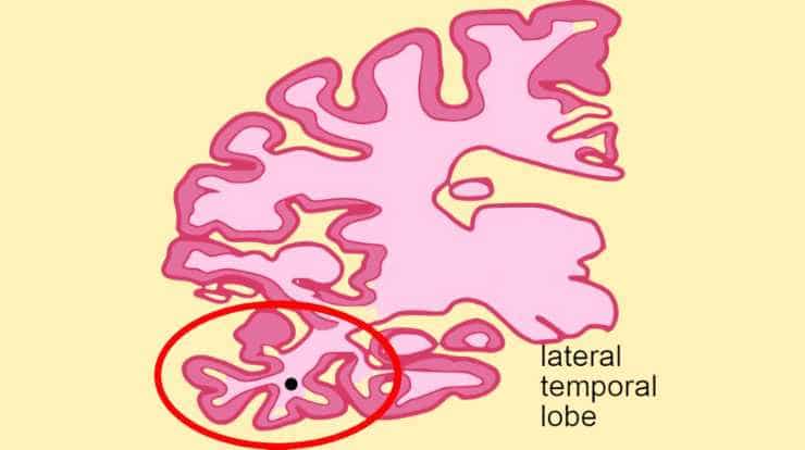 lateral temporal lobe