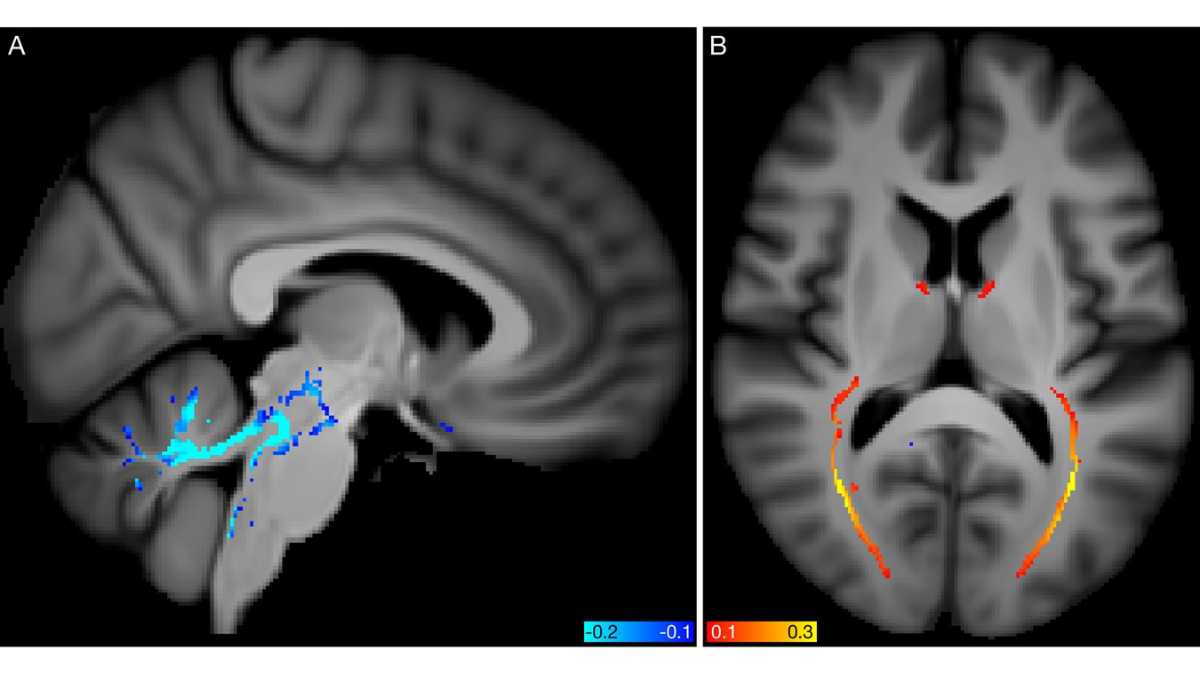 Spatial mapping of modes 5062 and 5362 from the diffusion MRI data
