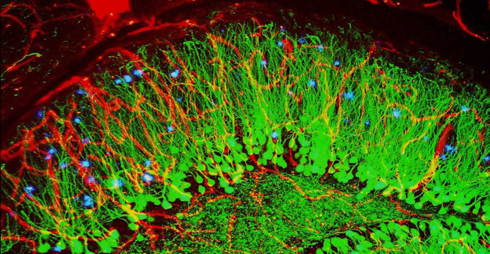Brain showing hallmarks of Alzheimer’s disease