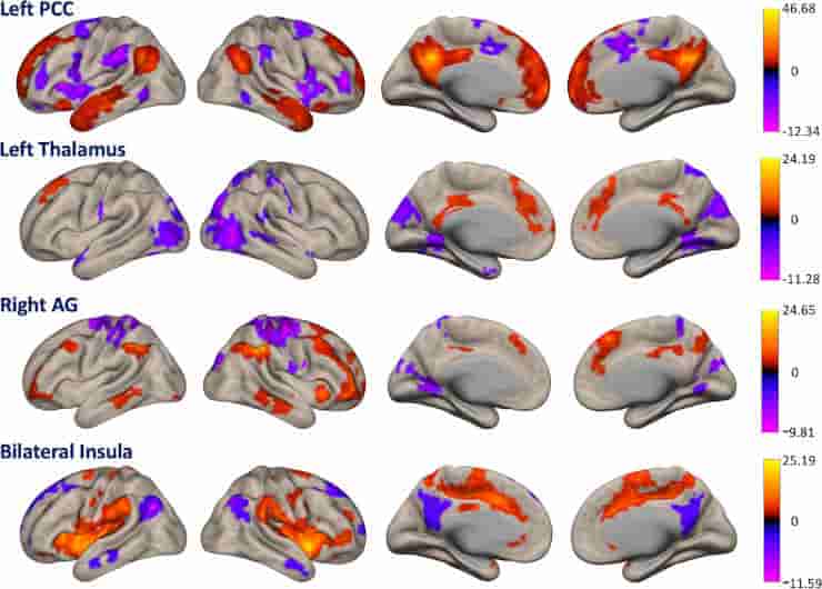Functional connectivity networks associated with the posterior cingulate cortex, thalamus, right angular gyrus, and bilateral insula