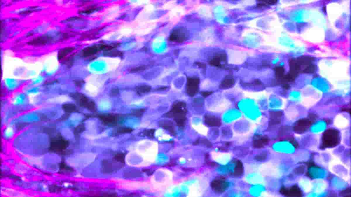 Neuroblastoma cells
