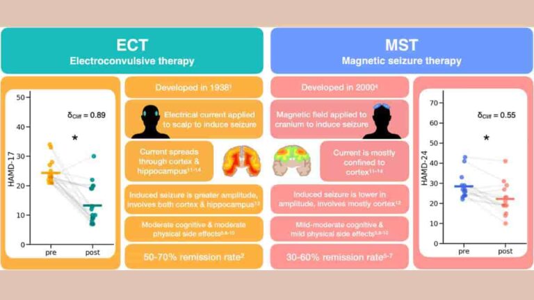ect magnetic seizure therapy