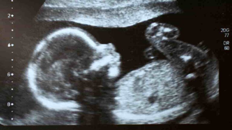 pregnancy ultrasound