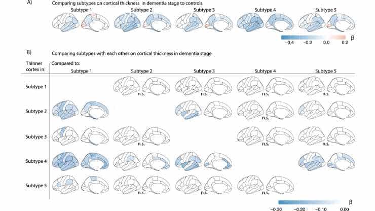 Comparing subtypes on cortical thickness in dementia stage